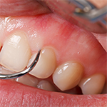 Dental Video - Gum Disease