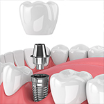 Dental Video - Dental Implants